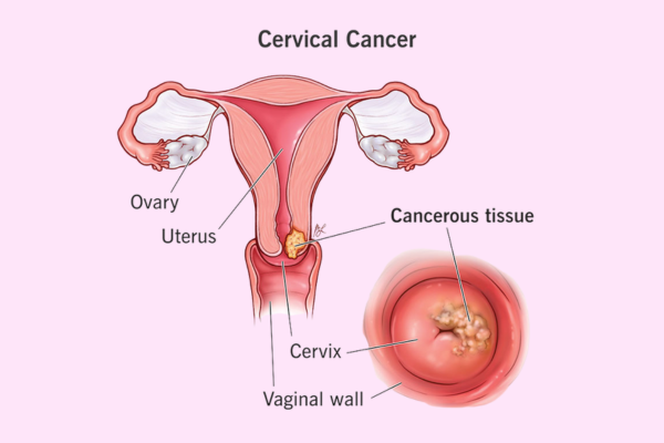 Cervical Cancer Screening